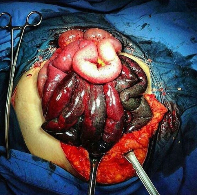 Mesenteric venous thrombosis