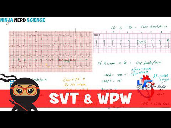 Supraventricular tachycardia and Wolff Parkinson White syndrome