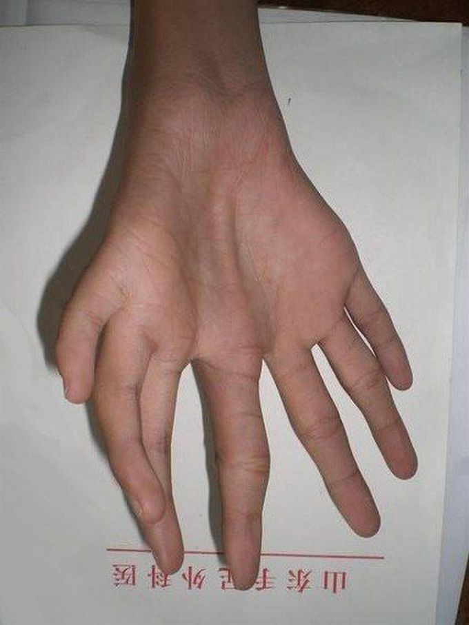 Mid ray duplication polydactyly, where the hand has an extra digit.