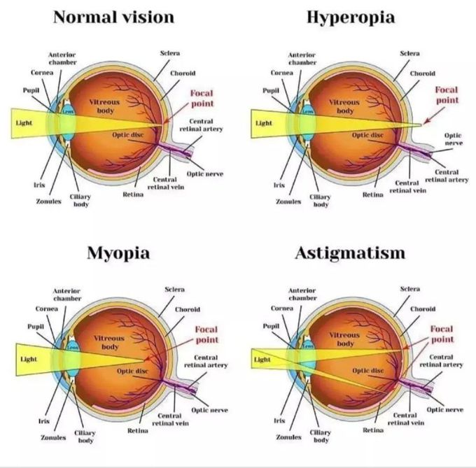 Eye Conditions