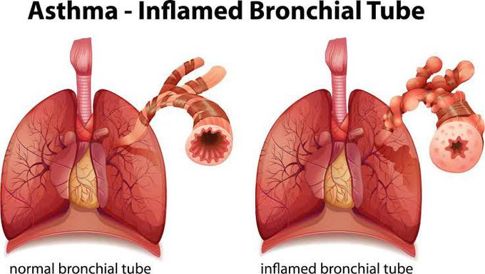 Symptoms of asthma