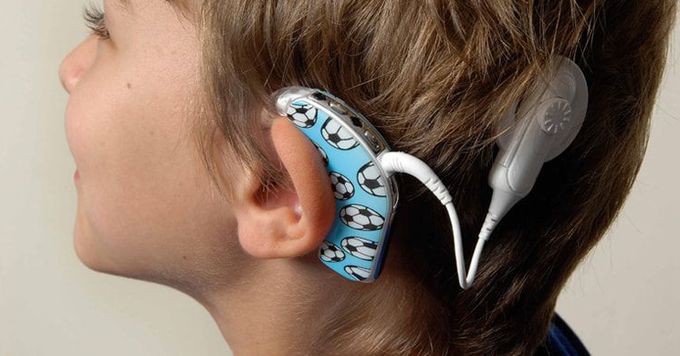 Cochlear Implants: The Structure and the Working