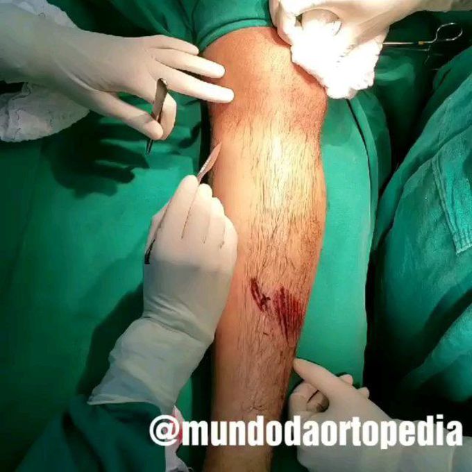 Compartment Syndrome and Fasciotomy