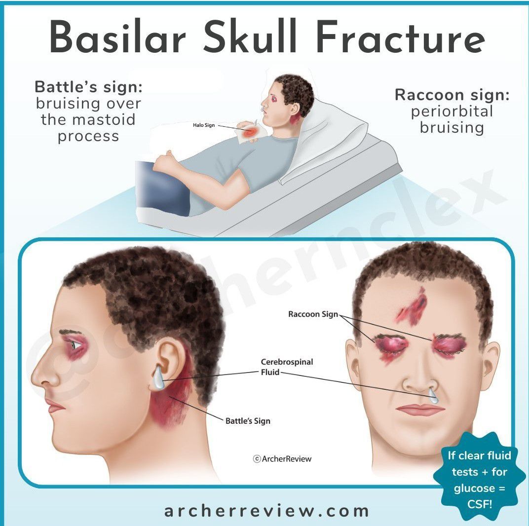 Basilar Skull Fracture - MEDizzy