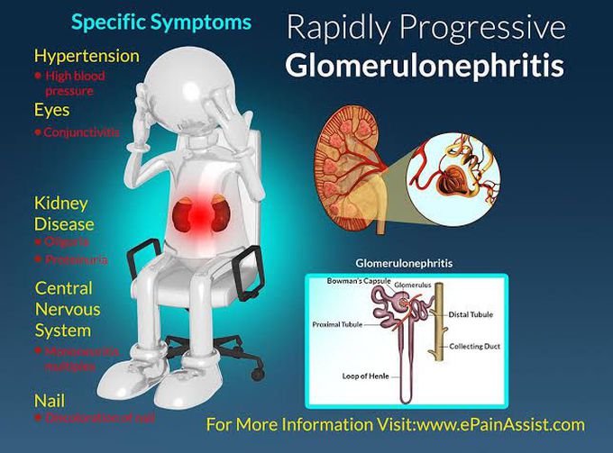 Glomerulonephritis symptoms