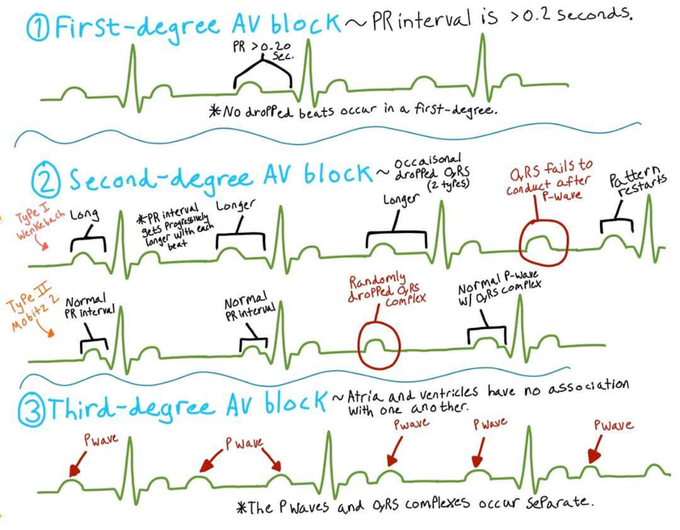 AV block