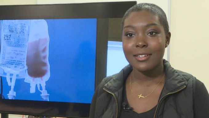 Alberta woman 1st adult in Canada to be 'cured' of sickle cell anemia through stem cell transplant
