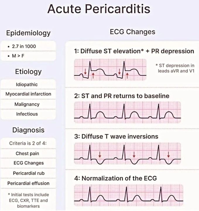 Acute Pericarditis