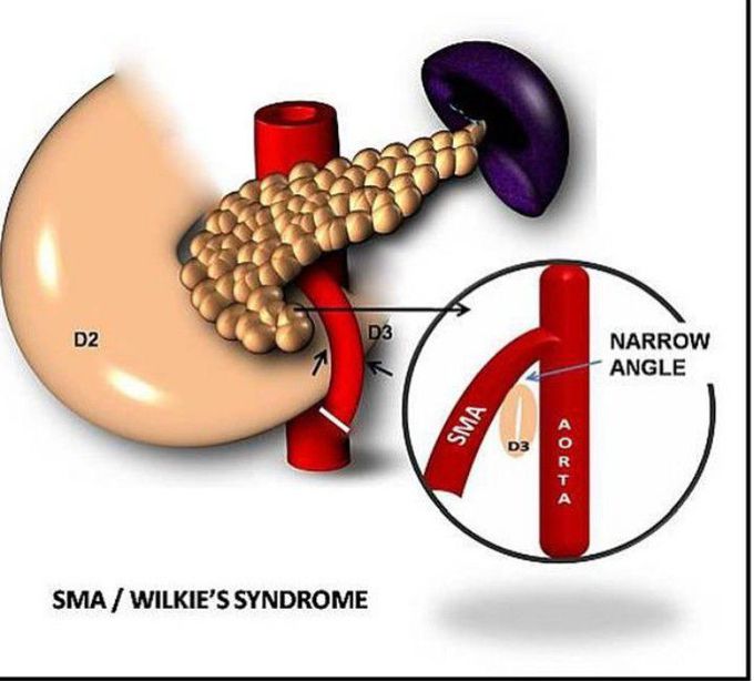 Wilkie's Syndrome