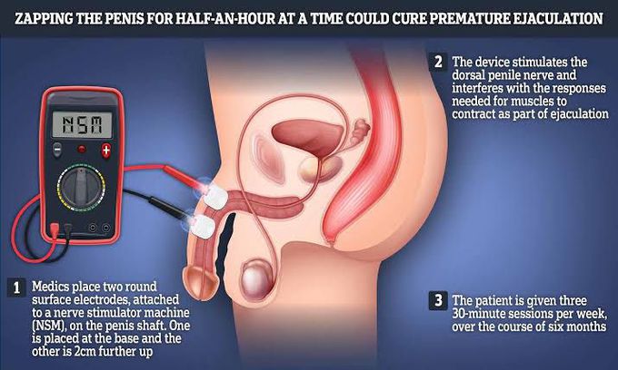 How to manage premature ejaculation MEDizzy