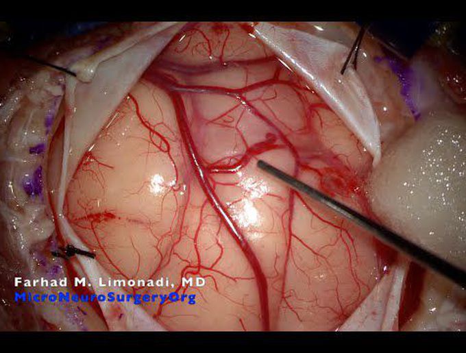 Brain tumor surgery: Aggressive Rhabdoid GBM near motor cortex in a young lady with paralysis.