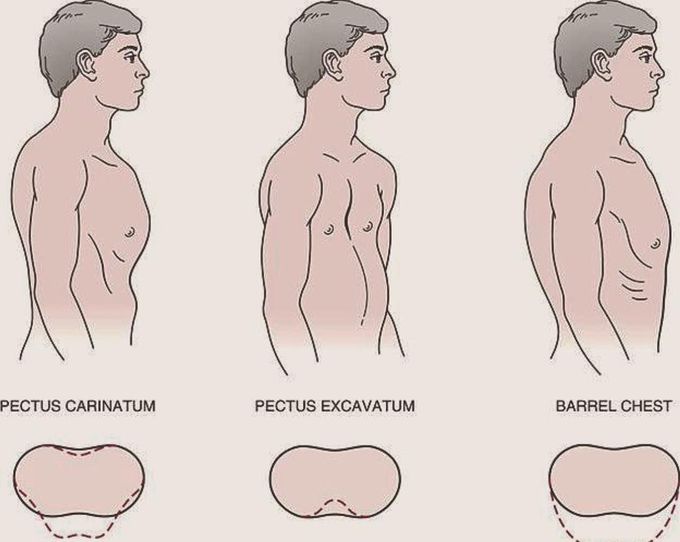 Chest wall deformities