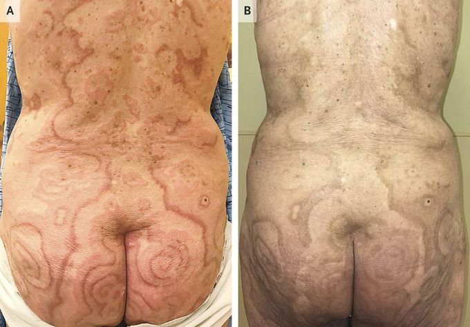 Erythema Gyratum Repens Associated with Anal Cancer