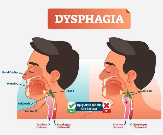 Dysphagia