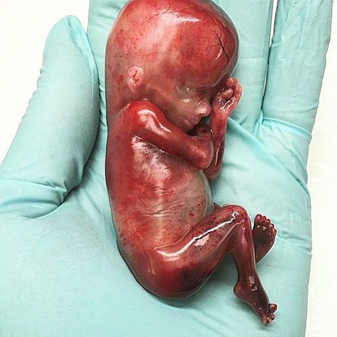 Spontaneous abortion (miscarriage)