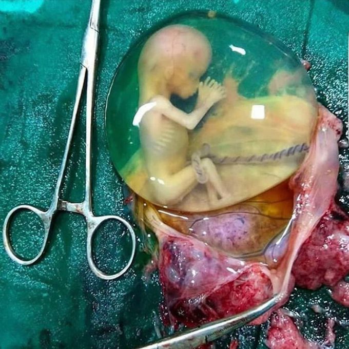 Deadly movement for a mother