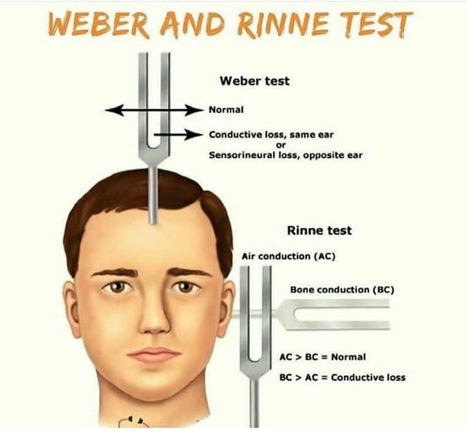 WEBER AND  RINNE TEST