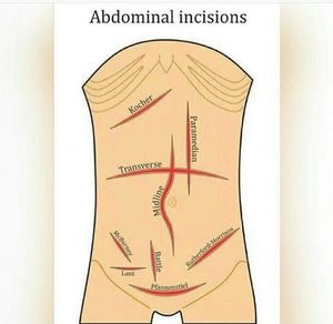 Abdominal Incisions - MEDizzy