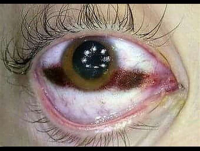 Black spots of the sclera