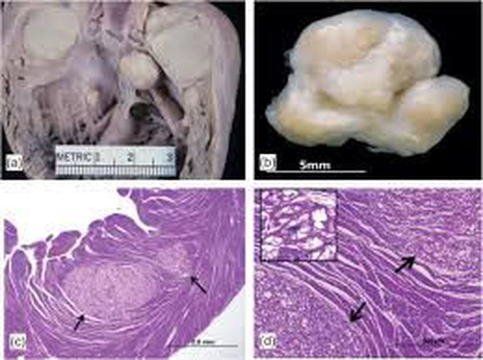Rhabdomyoma