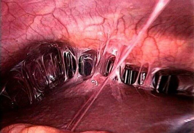 Fitz-Hugh-Curtis syndrome