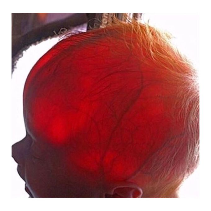 Transilumination of newborn head 😍