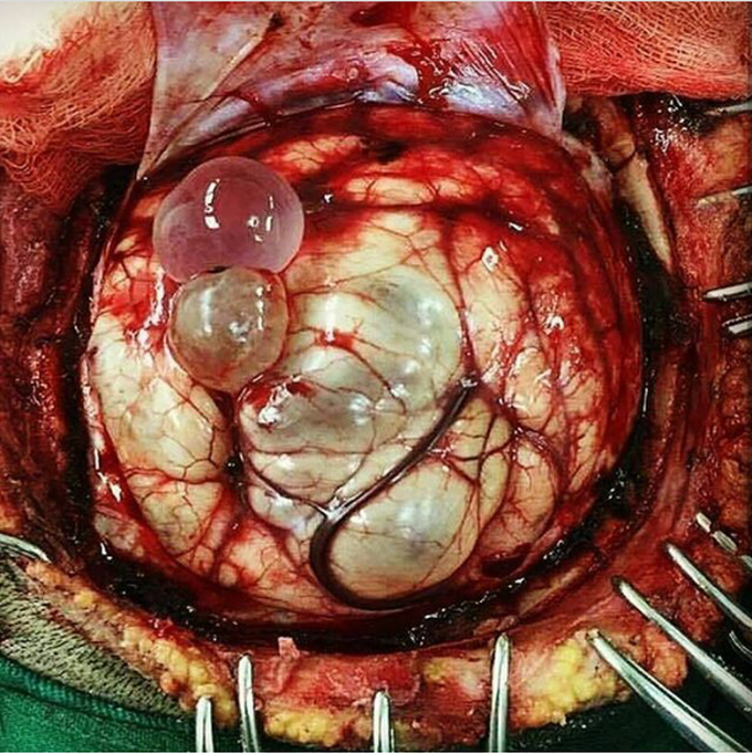 Neurocysticercosis