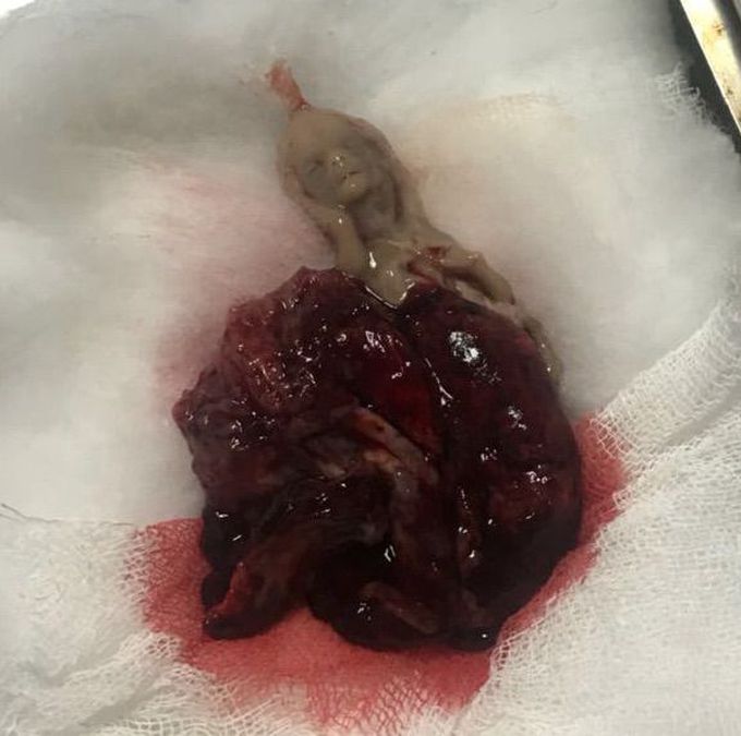 10 weeks foetus