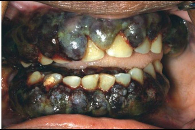 Oral manifestation of Leukemia