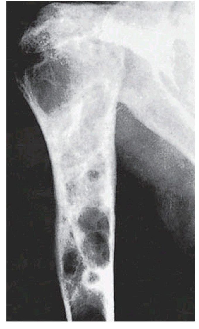 Hyperparathyroidism