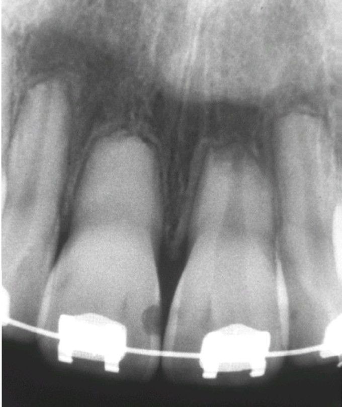 External resorption