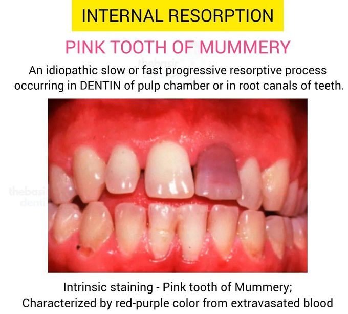 Internal Resorption I