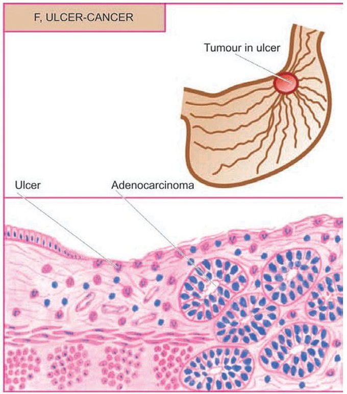 Gastric carcinoma