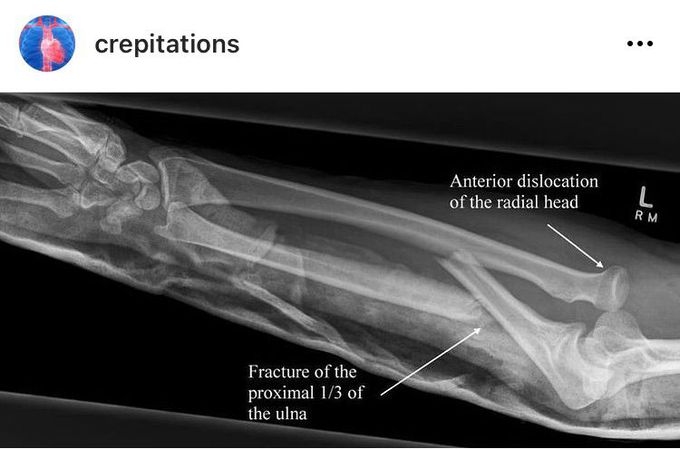 Monteggia Fracture (x-Ray)