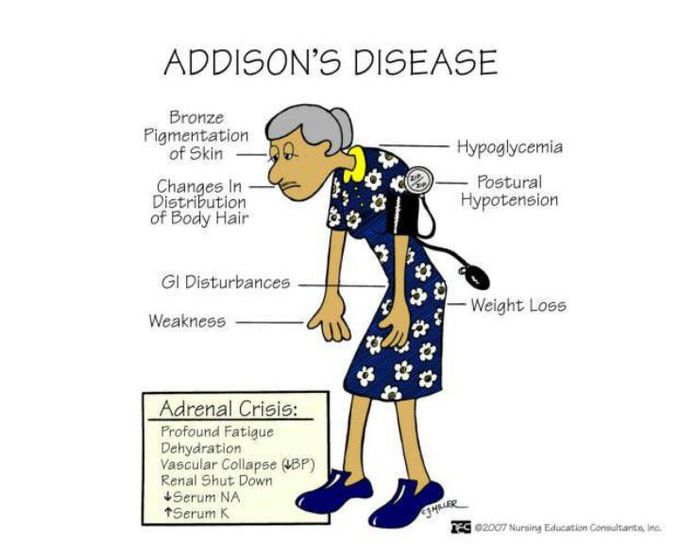 Addison's Disease