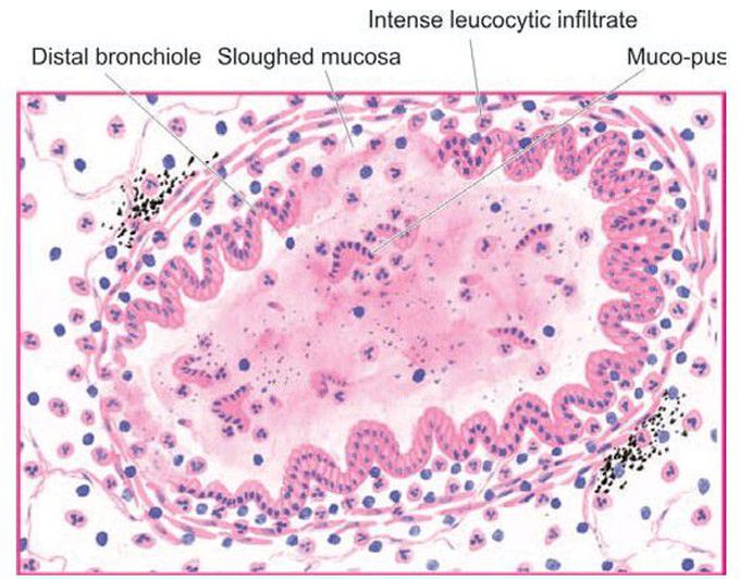 Dilated distal bronchiole