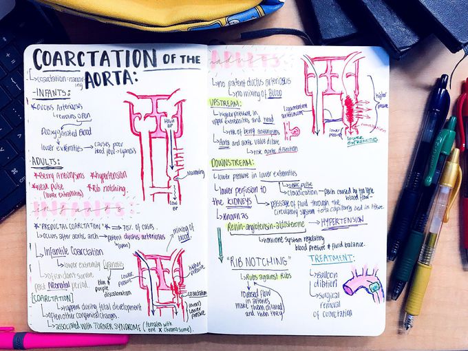 Aortic Coarctation