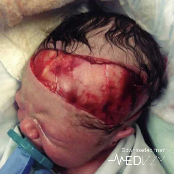Cut during c section
