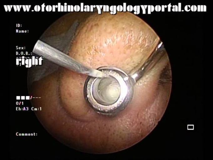 Antral Washout