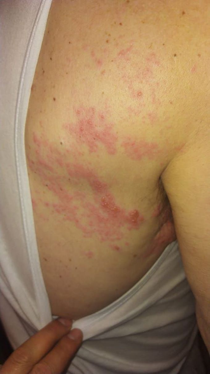 Herpes zoster