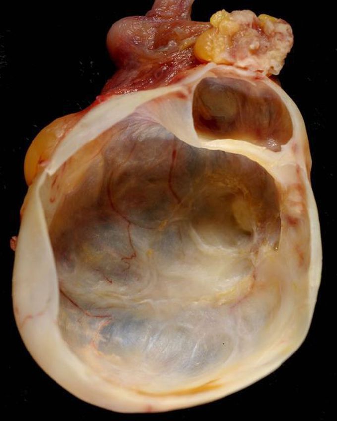 Mucinous cystadenoma of ovary