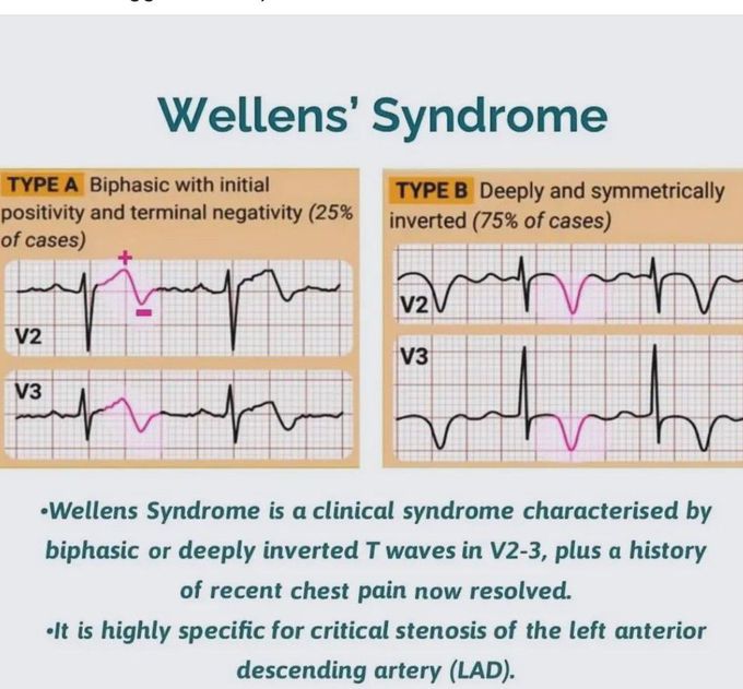 Wellen Syndrome