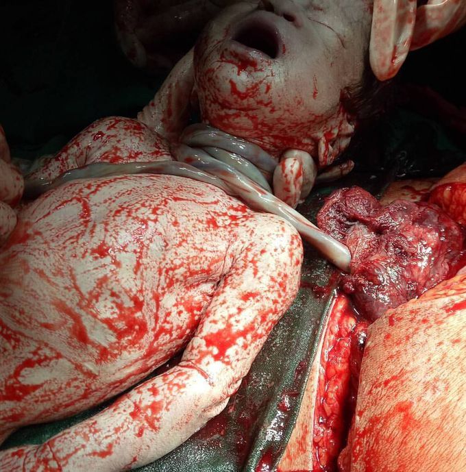 A case of cesarean section due to nuchal cord