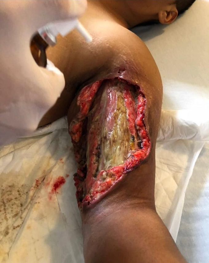 Extensive soft tissue necrosis due to a spider bite!  