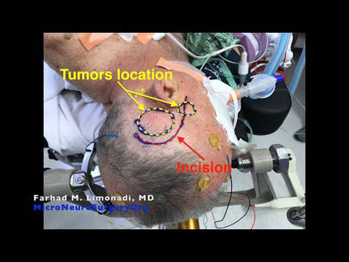 Two Brain tumors found to be Multinodular Glioblastoma.  Awake Craniotomy and surgical resection.