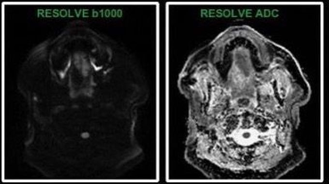 MR Imaging of the head and neck - Tongue cancer