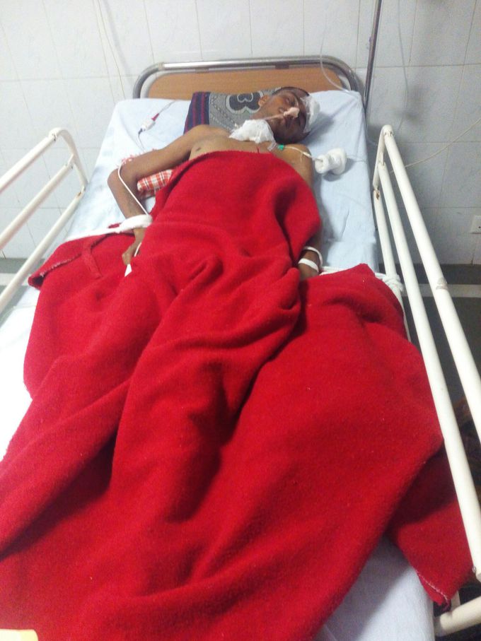 Trauma patient having severe accident , result in blood clot in head region.