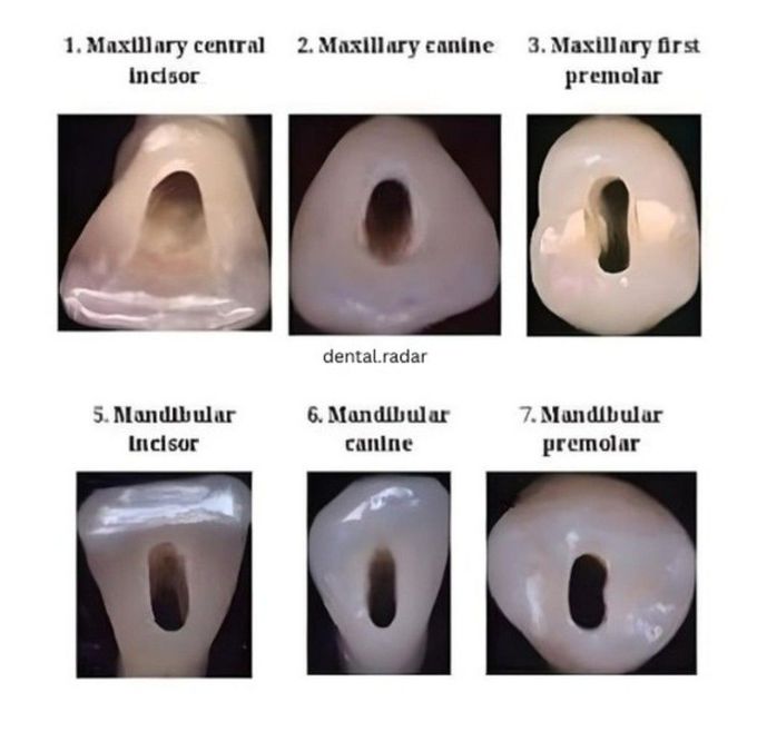Root Canal Shape