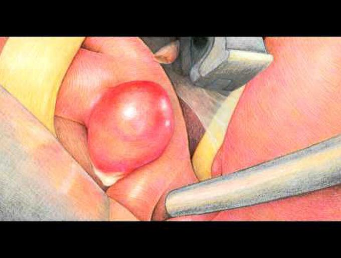 Clipping of ipsilateral posterior communicating and superior cerebellar artery aneurysms