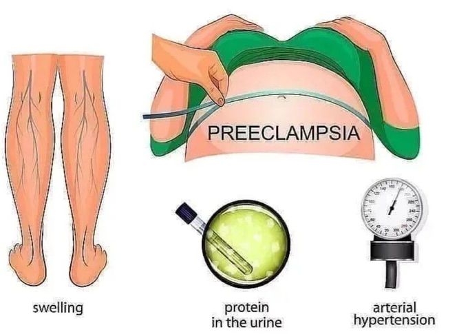 Preeclampsia